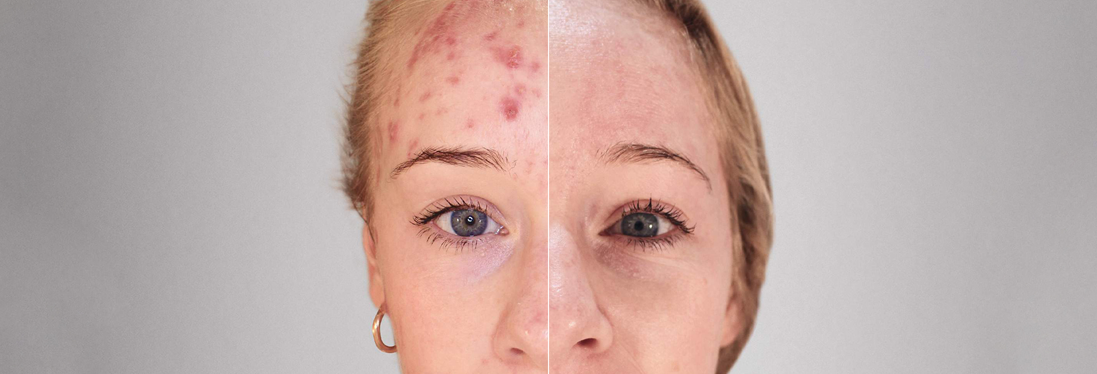 Kleresca Acne Treatment