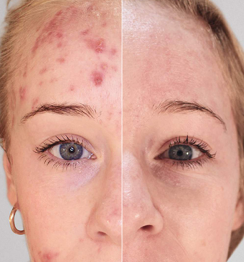 Kleresca Acne Treatment